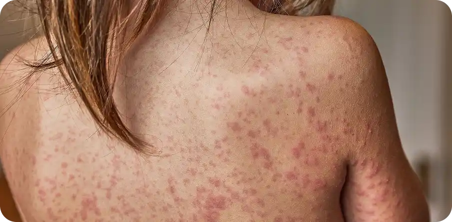 Varicela en adultos